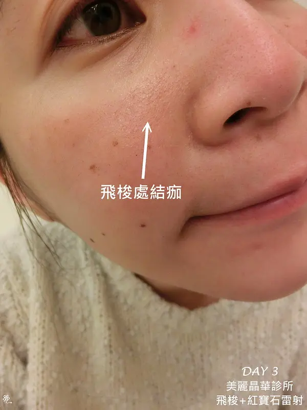紅寶石雷射與飛梭雷射術後第三天