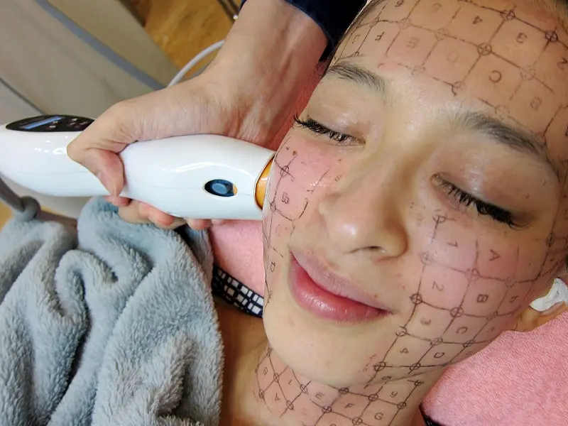 CPT電波拉皮-網路名人薛妞妞治療分享