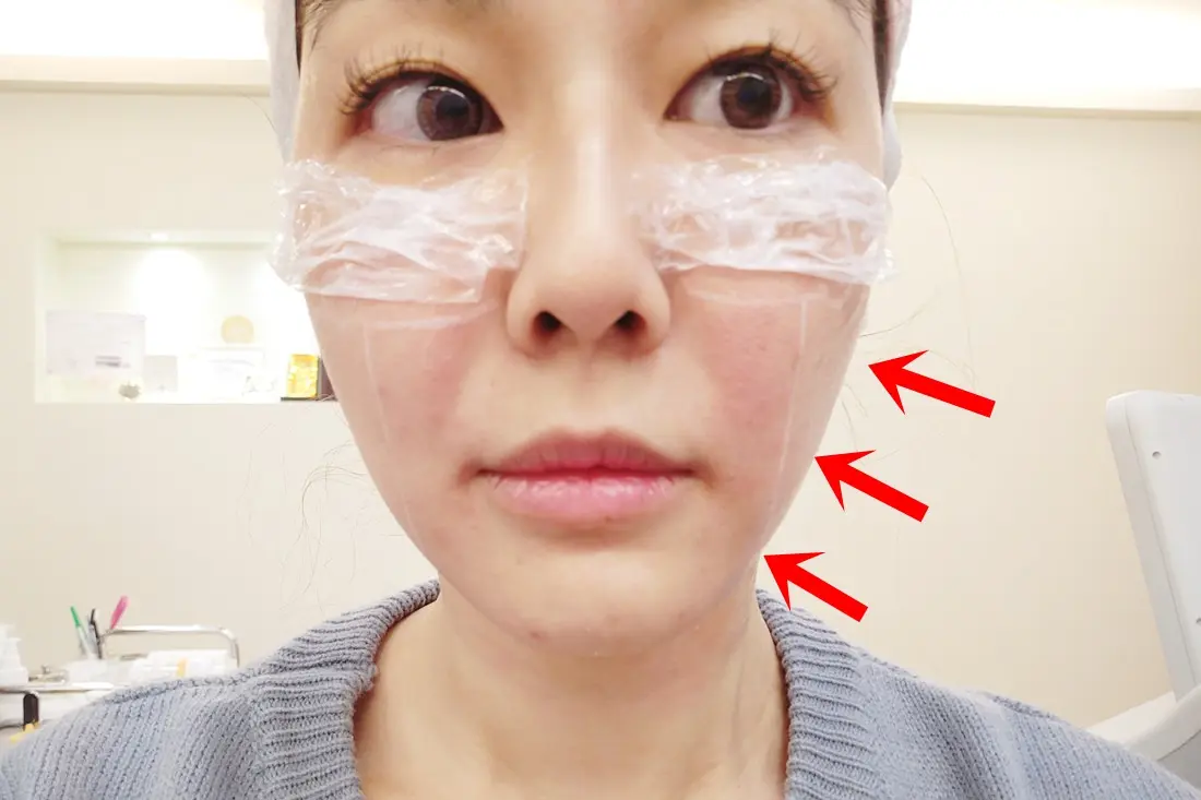 極線音波拉皮治療右半邊臉後立刻拉提