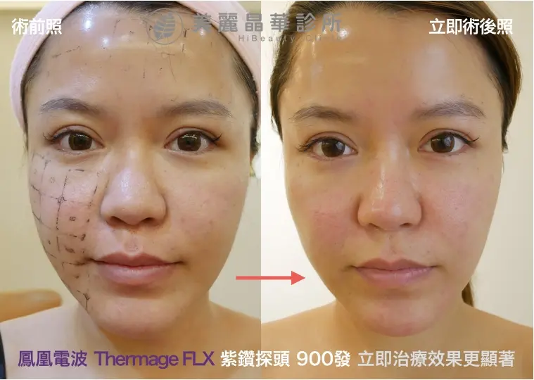 FLX鳳凰電波拉皮網路名人momoco術後立即照