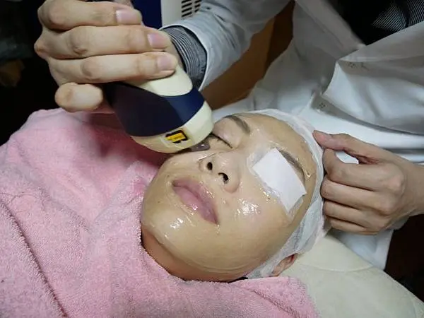 光纖粉餅雷射治療黑眼圈