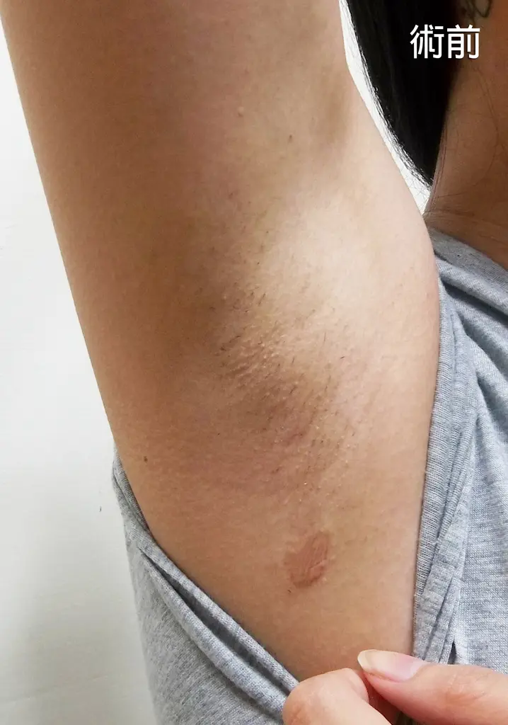 腋下雷射除毛術前照