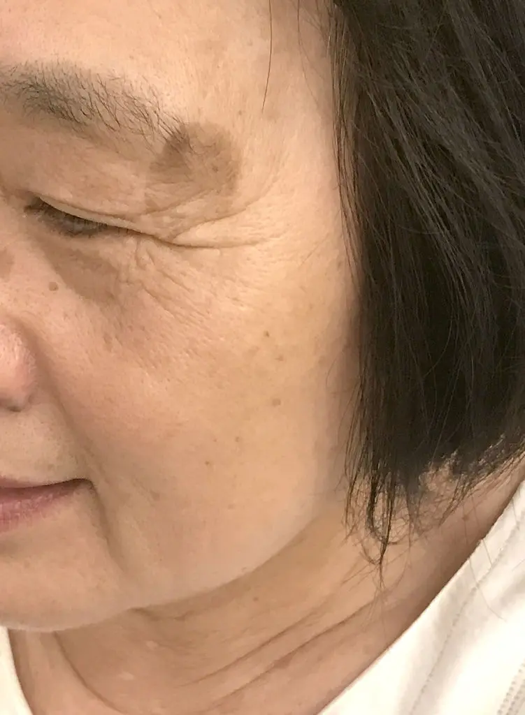 紅寶石除斑雷射