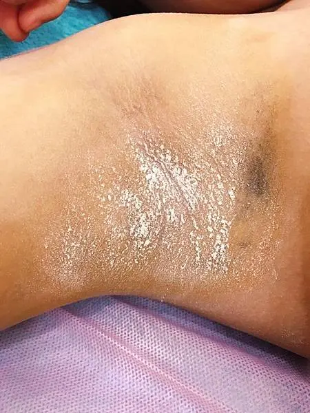 Miradry腋淨爽術後出汗改善