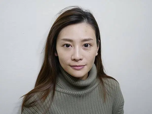 光纖粉餅雷射術前