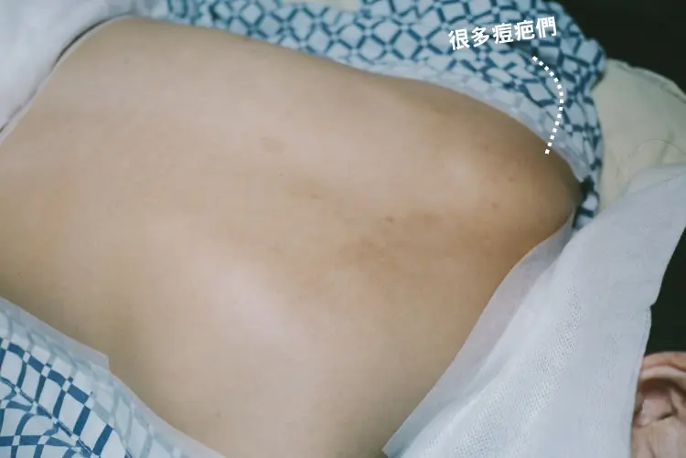 粉餅雷射美背治療術前照