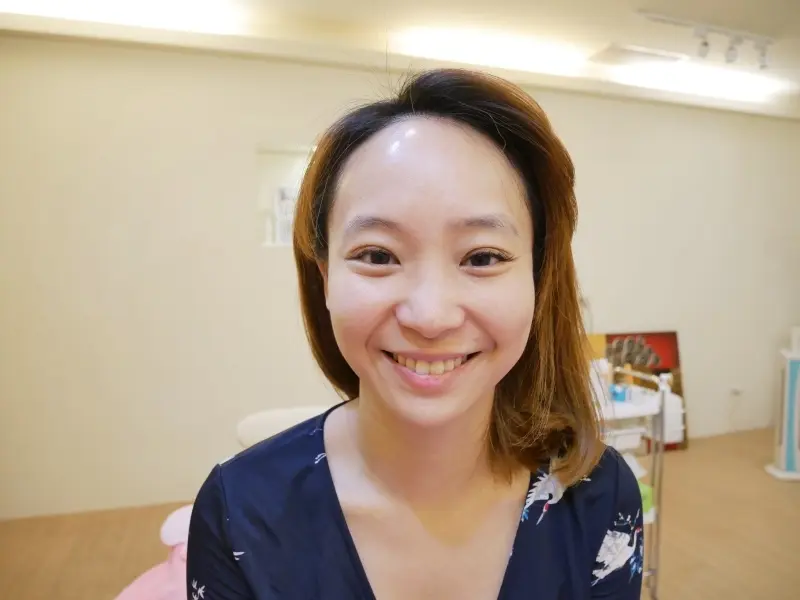 ulthera極線音波拉皮術後無傷口