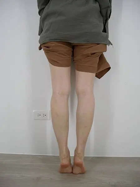 肉毒瘦小腿術後