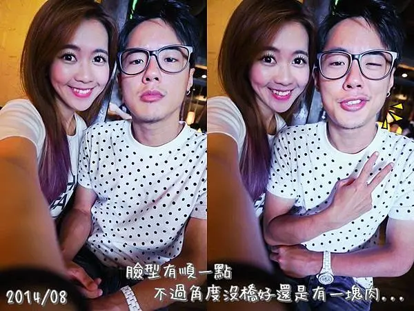 肉毒瘦臉治療後