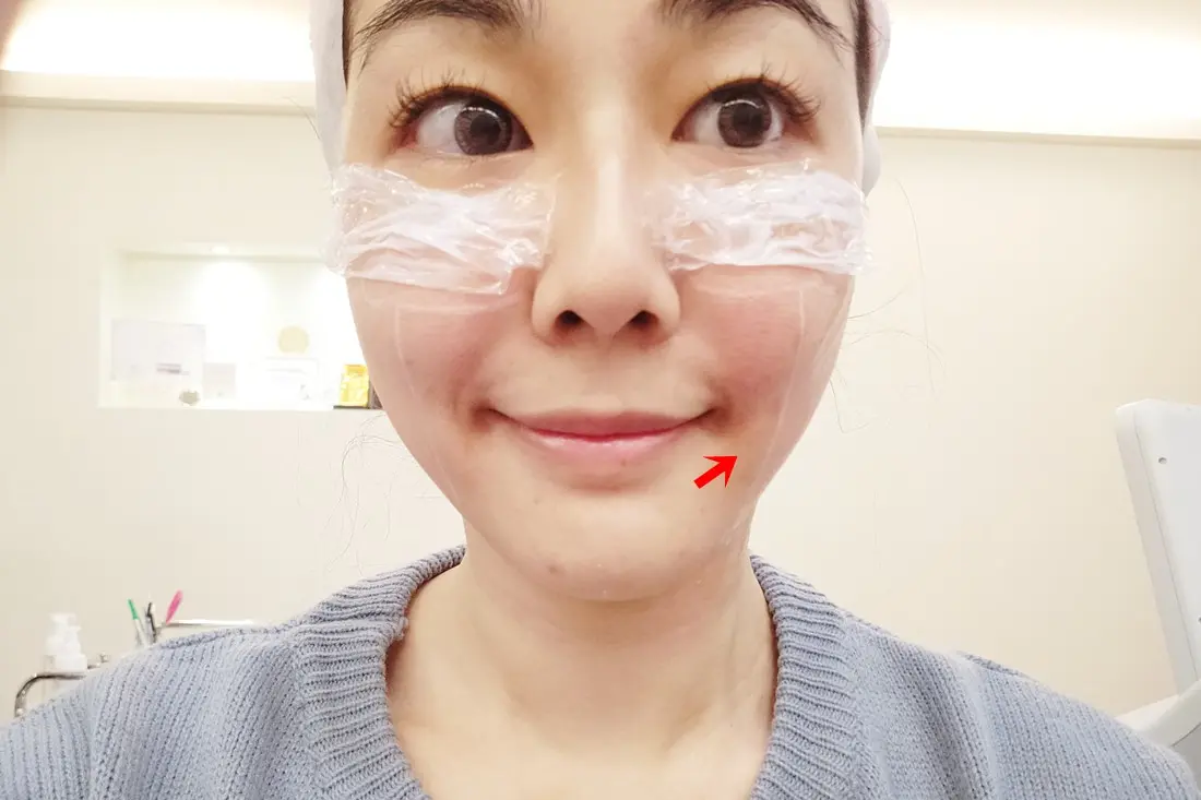 極線音波拉皮治療右半邊臉後立刻拉提