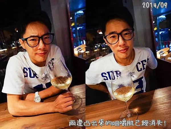 肉毒瘦臉術後下巴輪廓明顯