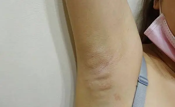 Miradry腋淨爽術後三天紅腫逐漸消失