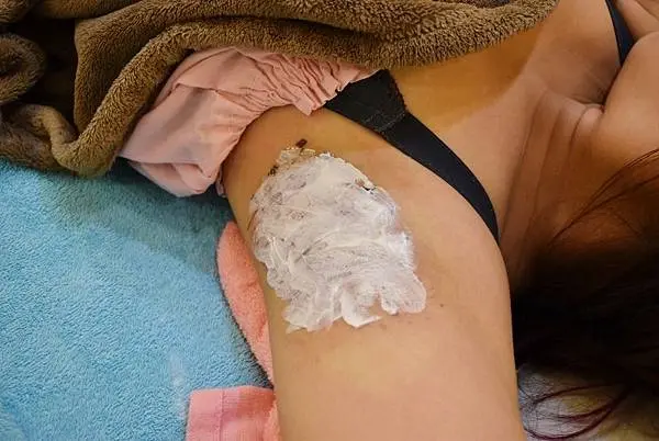 Miradry腋淨爽