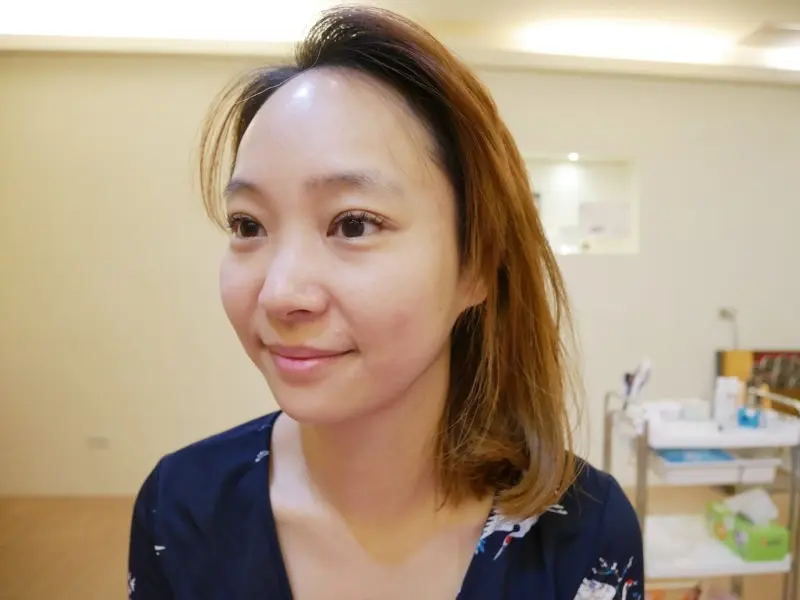 ulthera極線音波拉皮術後拉提效果