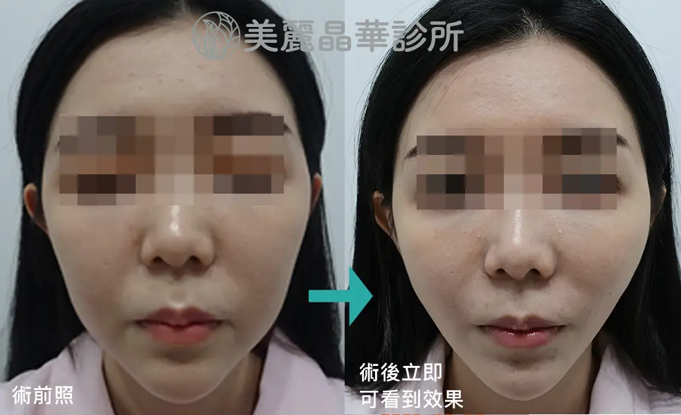 埋線拉提術後效果