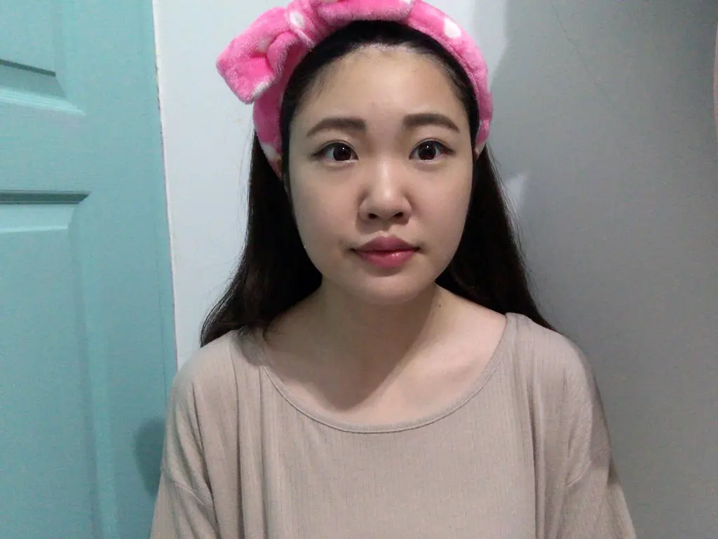肉毒瘦小臉術後一個月