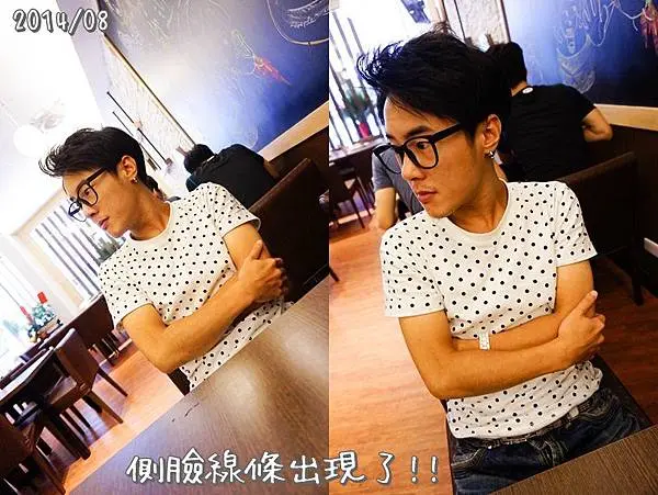 肉毒瘦臉治療後側臉線條出現