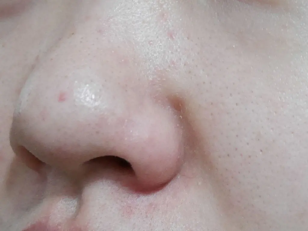 水涵氧&保濕導入術前鼻頭粉刺近照