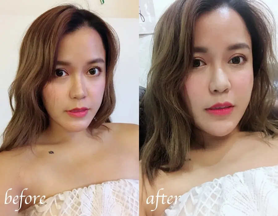玻尿酸八點拉提術前術後差異比較