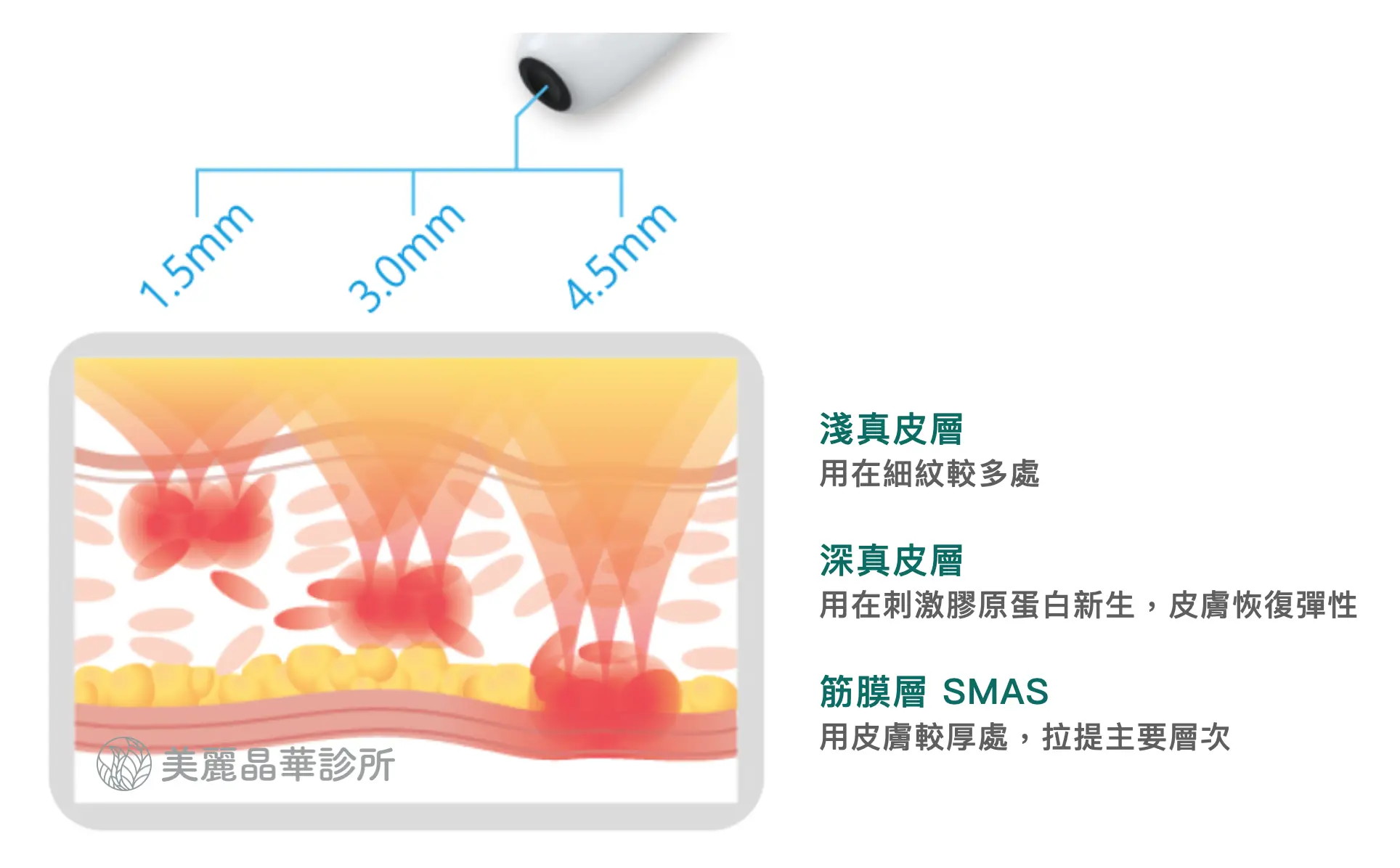 渦旋音波 拉提具備1.5mm，3.0mm和4.5mm三種治療深度，分別對於深淺真皮層和筋膜層進行多層次拉提。
