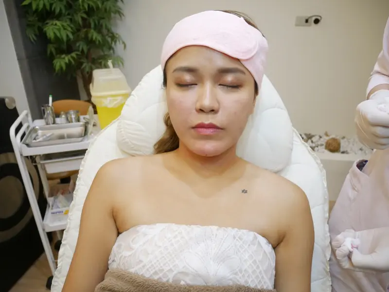 玻尿酸八點拉提治療