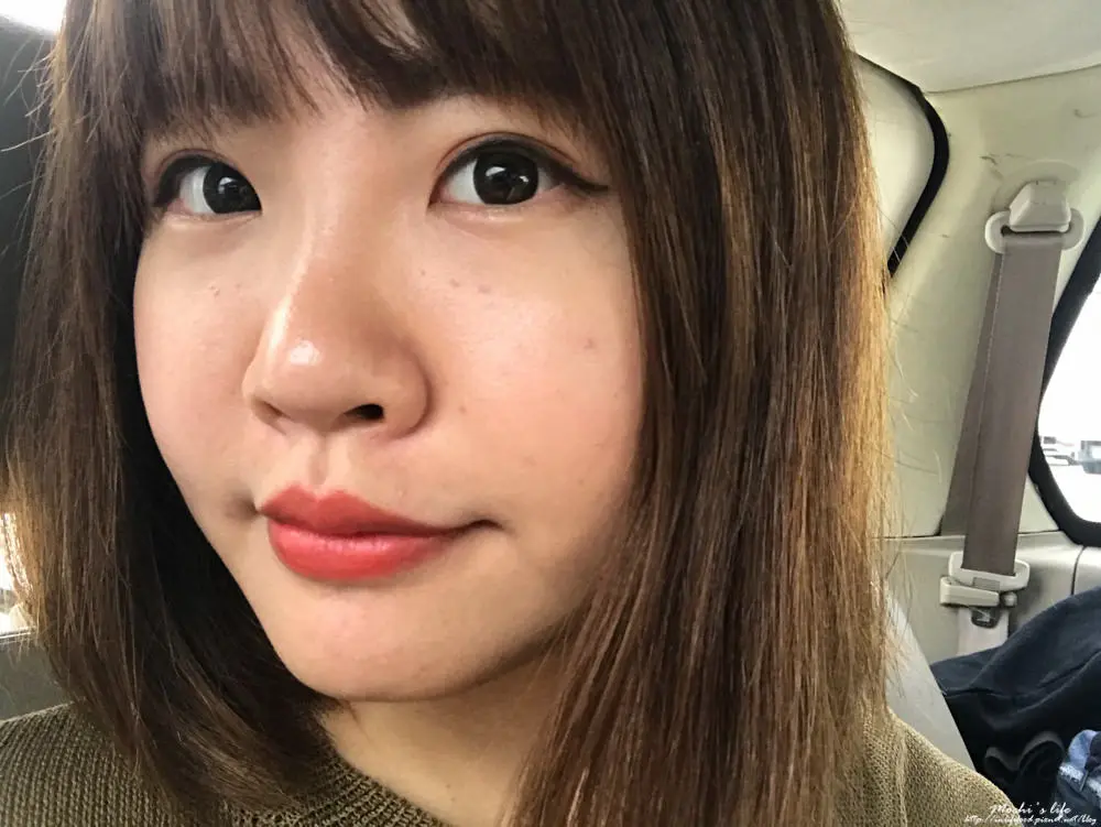 玻尿酸法令紋淚溝術後
