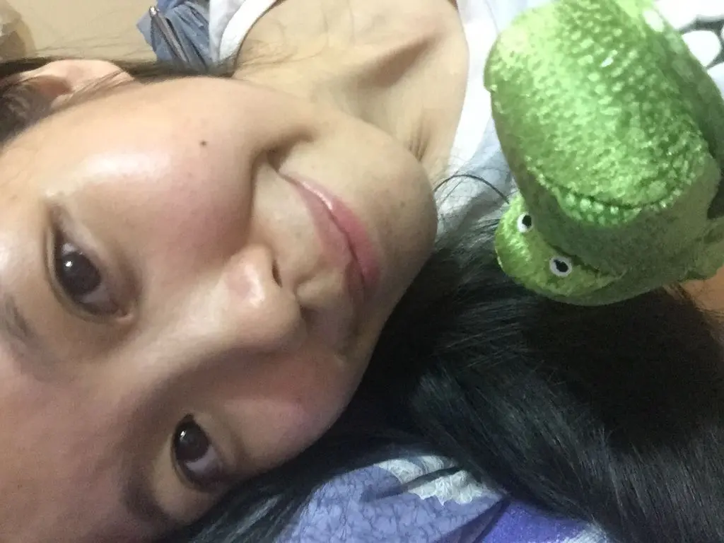 3D聚左旋乳酸術後膠原增生膚況變好