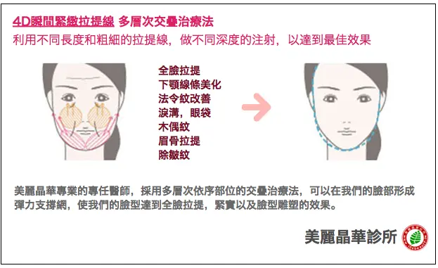 4D瞬間緊緻埋線拉提多層次交疊治療法