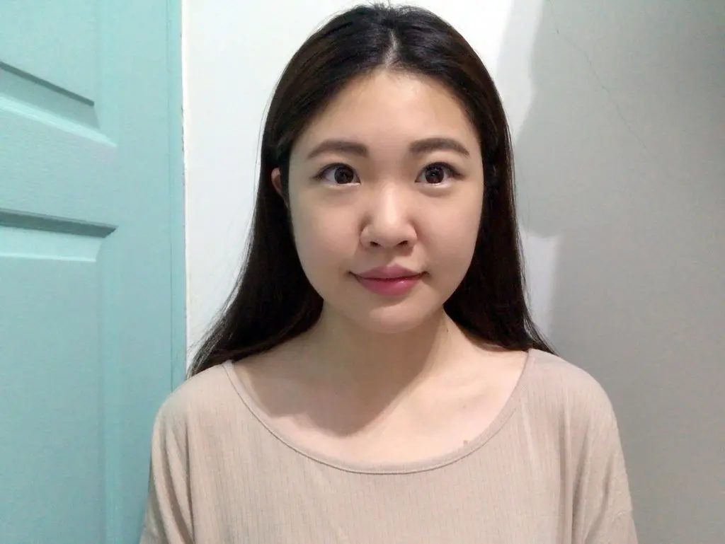 肉毒瘦小臉術後一個月