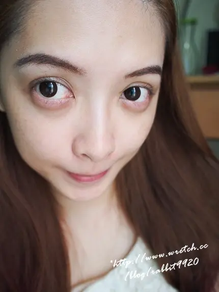 杏仁酸+水涵氧換膚-網路名人滕培培治療分享