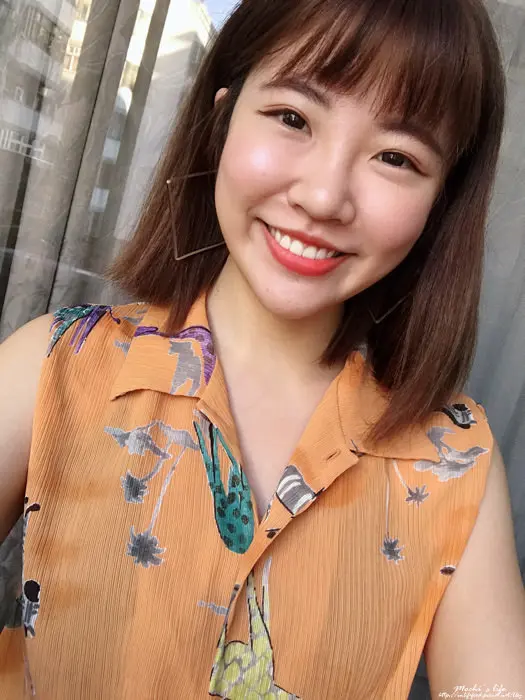 玻尿酸治療前淚溝明顯