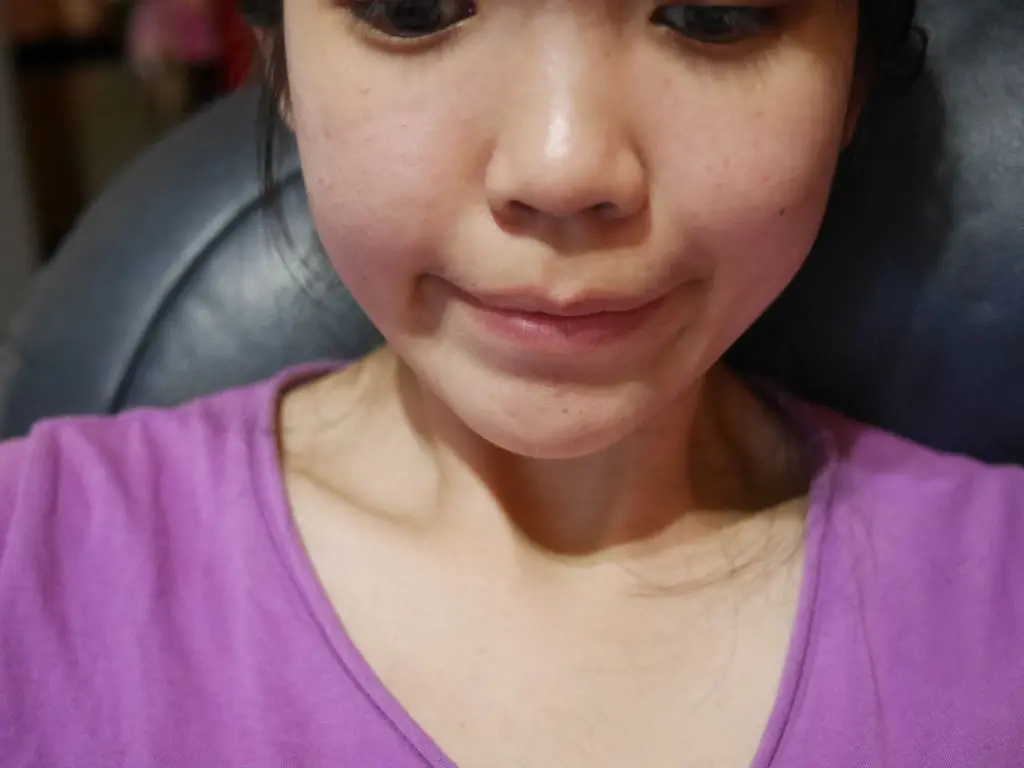 3D聚左旋乳酸術後