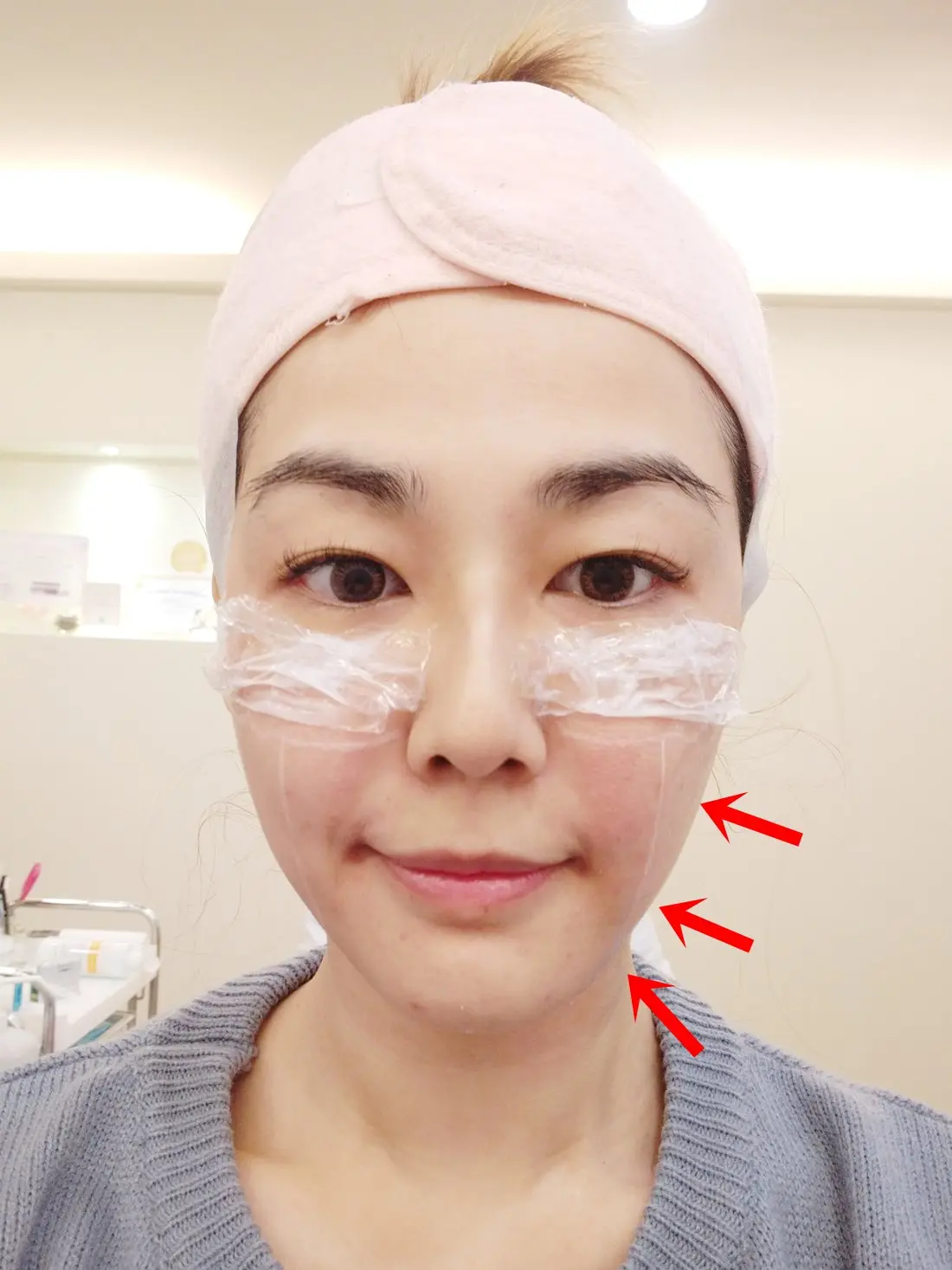 極線音波拉皮治療右半邊臉後立刻拉提