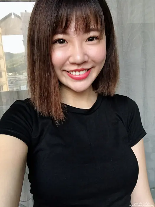 玻尿酸法令紋淚溝治療前