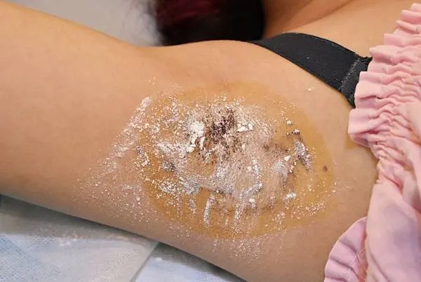 Miradry腋淨爽不用手術不用修復期