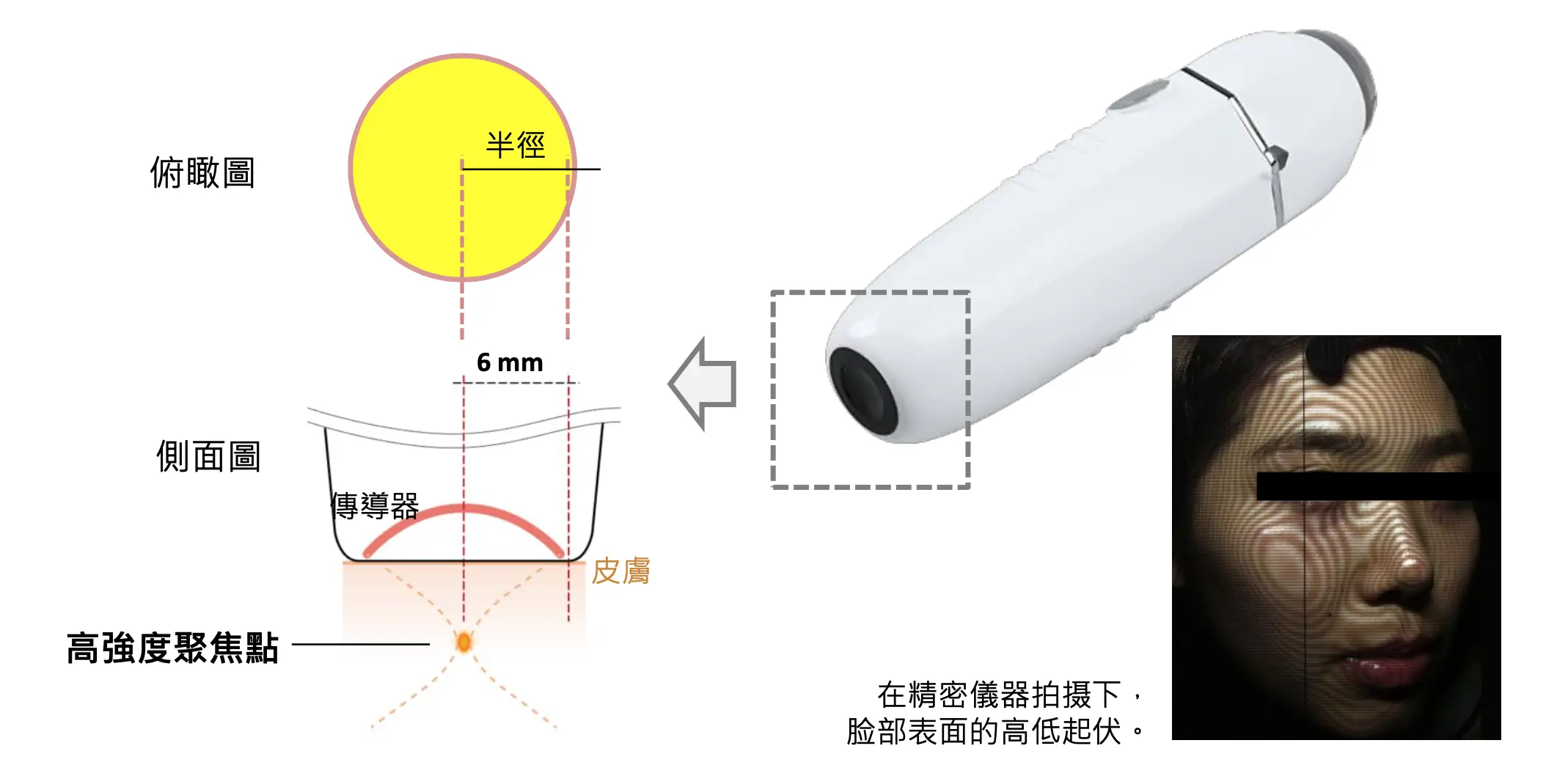 渦旋音波 拉提更能貼近小部位，如眼周、下顎線等細微部位治療