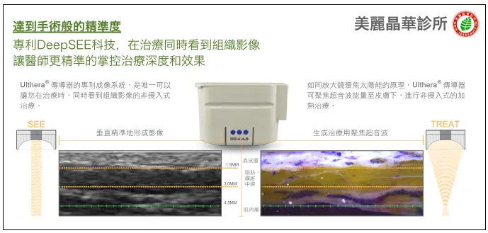 極線音波拉皮達到手術般的精準度