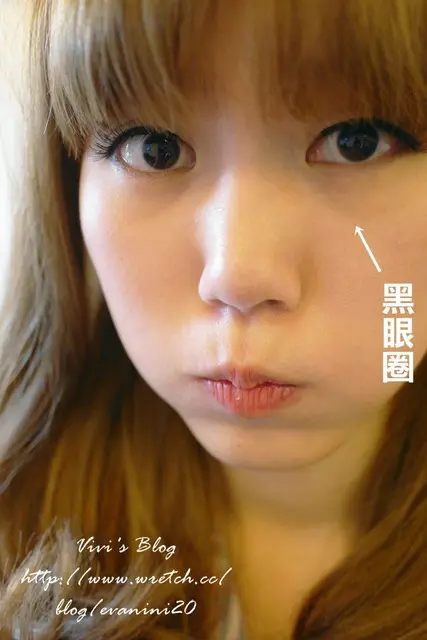 玻尿酸淚溝術前明顯黑眼圈