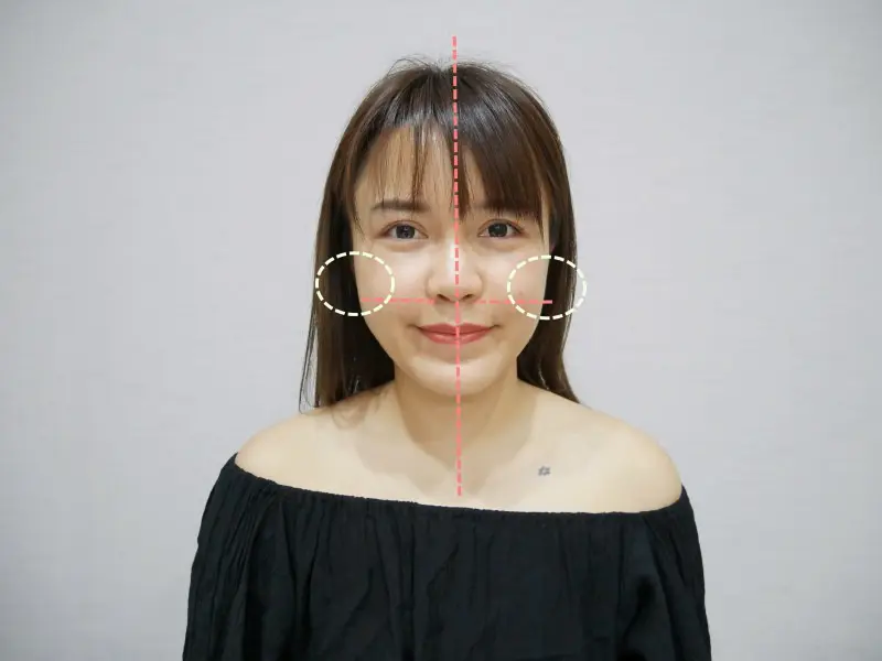 FLX鳳凰電波術前明顯大小臉