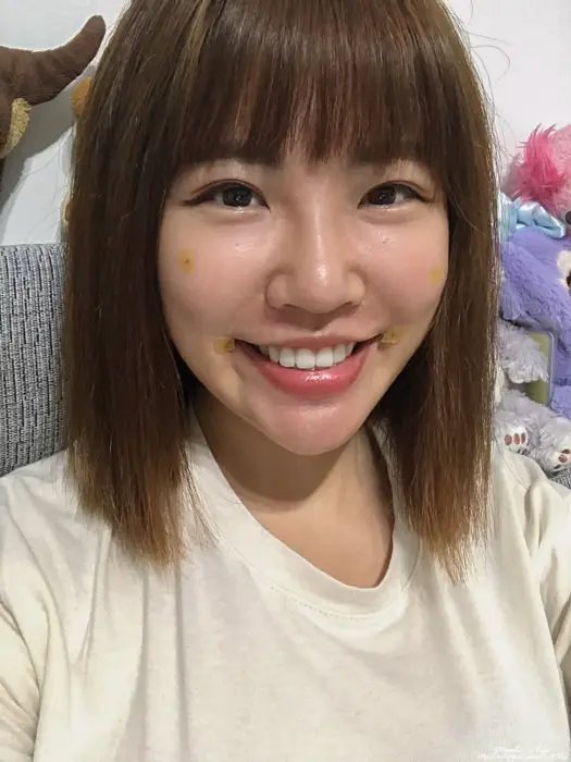 玻尿酸法令紋淚溝術後