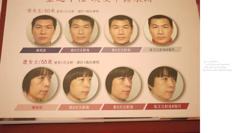 3D聚左旋乳酸案例術前術後差異比對