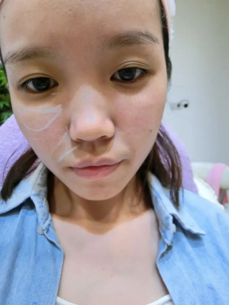 3D聚左旋乳酸治療前標記治療位置