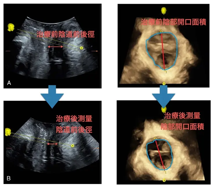 EMSELLA幸福G動椅治療私密處核心肌肉群