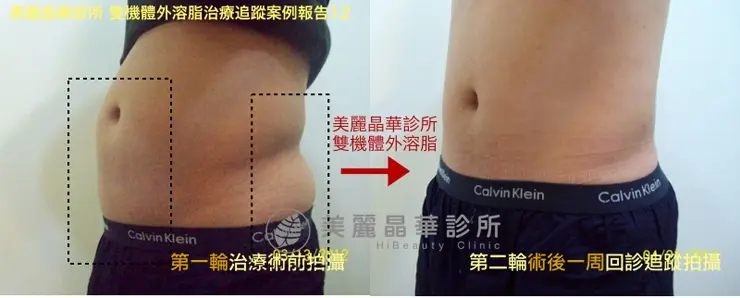 雙機體外減脂術前術後比對