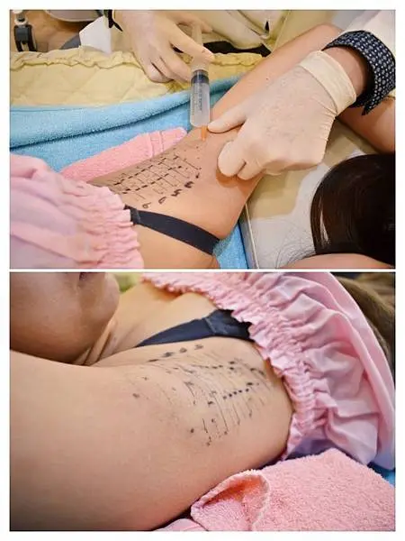 Miradry腋淨爽術前