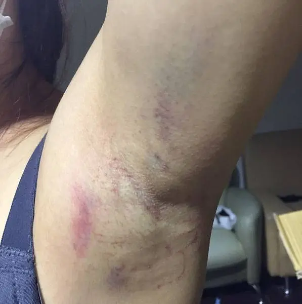 Miradry腋淨爽術後無傷口