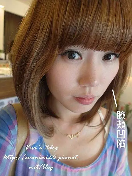 3D聚左旋乳酸治療前臉頰凹陷