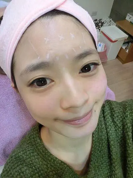 肉毒桿菌抬頭紋術前
