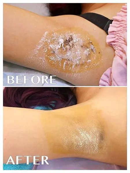 Miradry腋淨爽術前術後差異比較