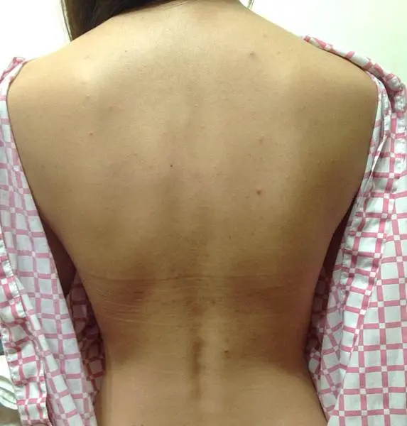 杏仁酸美背術前
